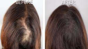 Hair Revital X – pour la perte de cheveux - forum – Amazon – effets